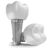 dental implants