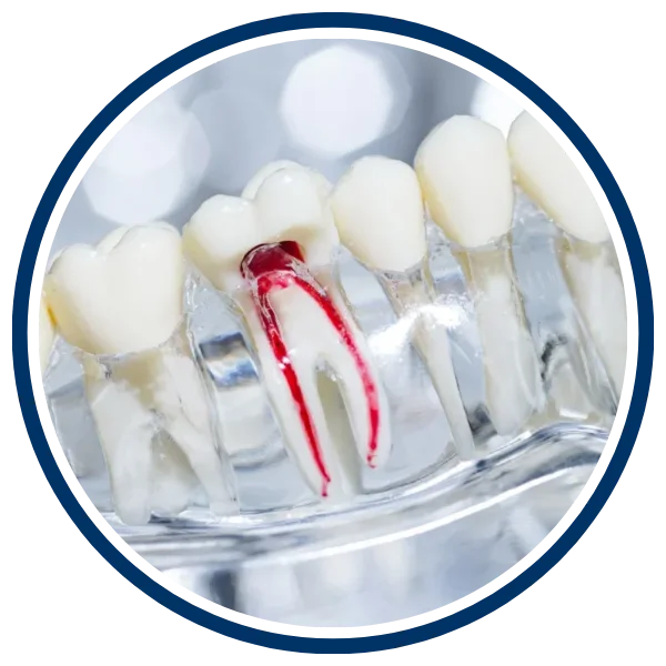 root-canal-treatment
